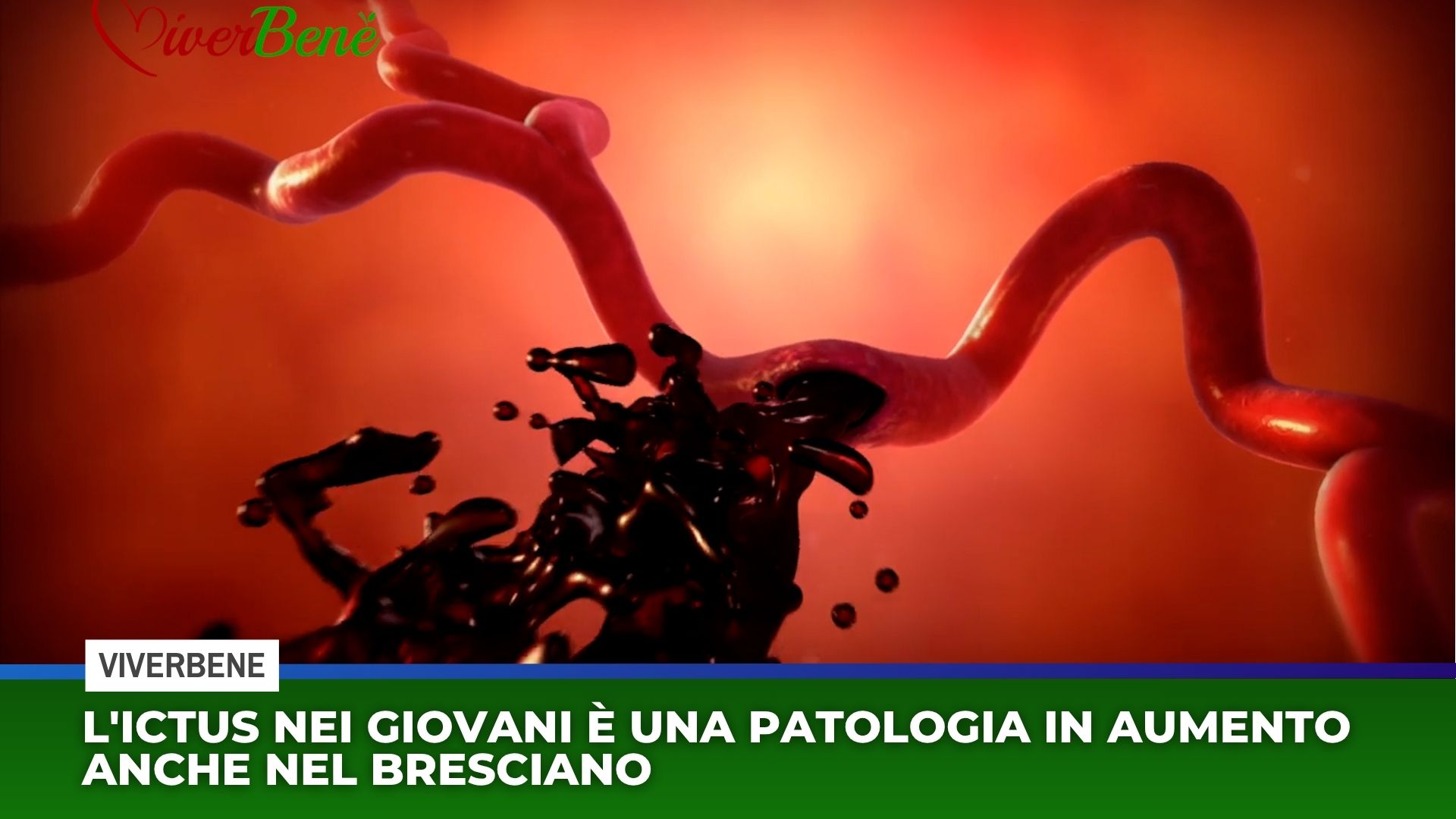 L’ictus nei giovani è una patologia in aumento anche nel bresciano