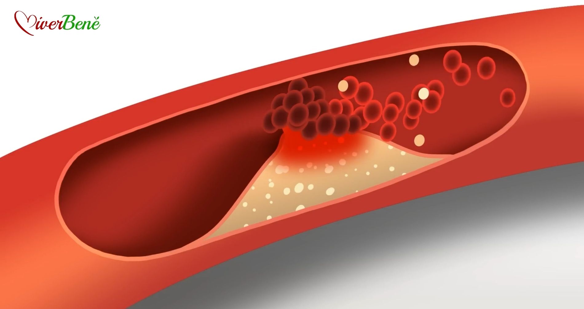 Colesterolo: ridurre quello cattivo e aumentare quello buono. Cosa fare a tavola