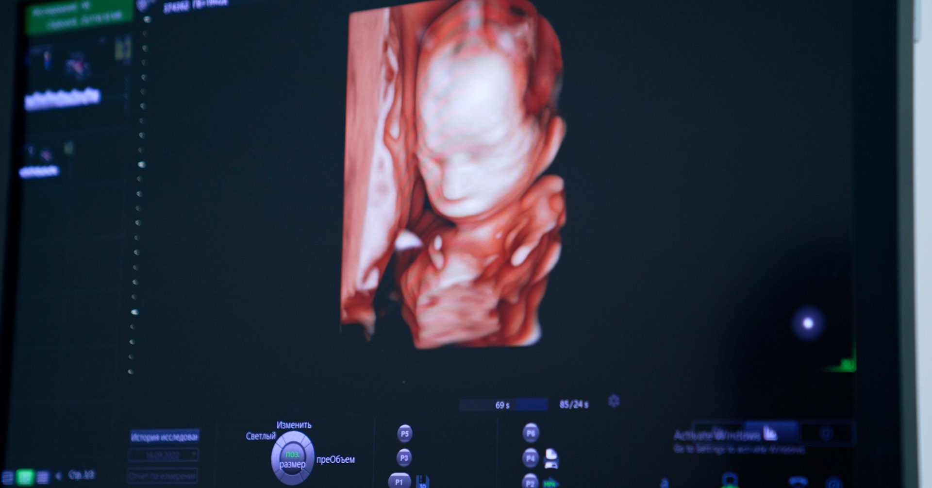 Scoperta un'interferenza immunitaria materna e lo sviluppo cerebrale del bambino