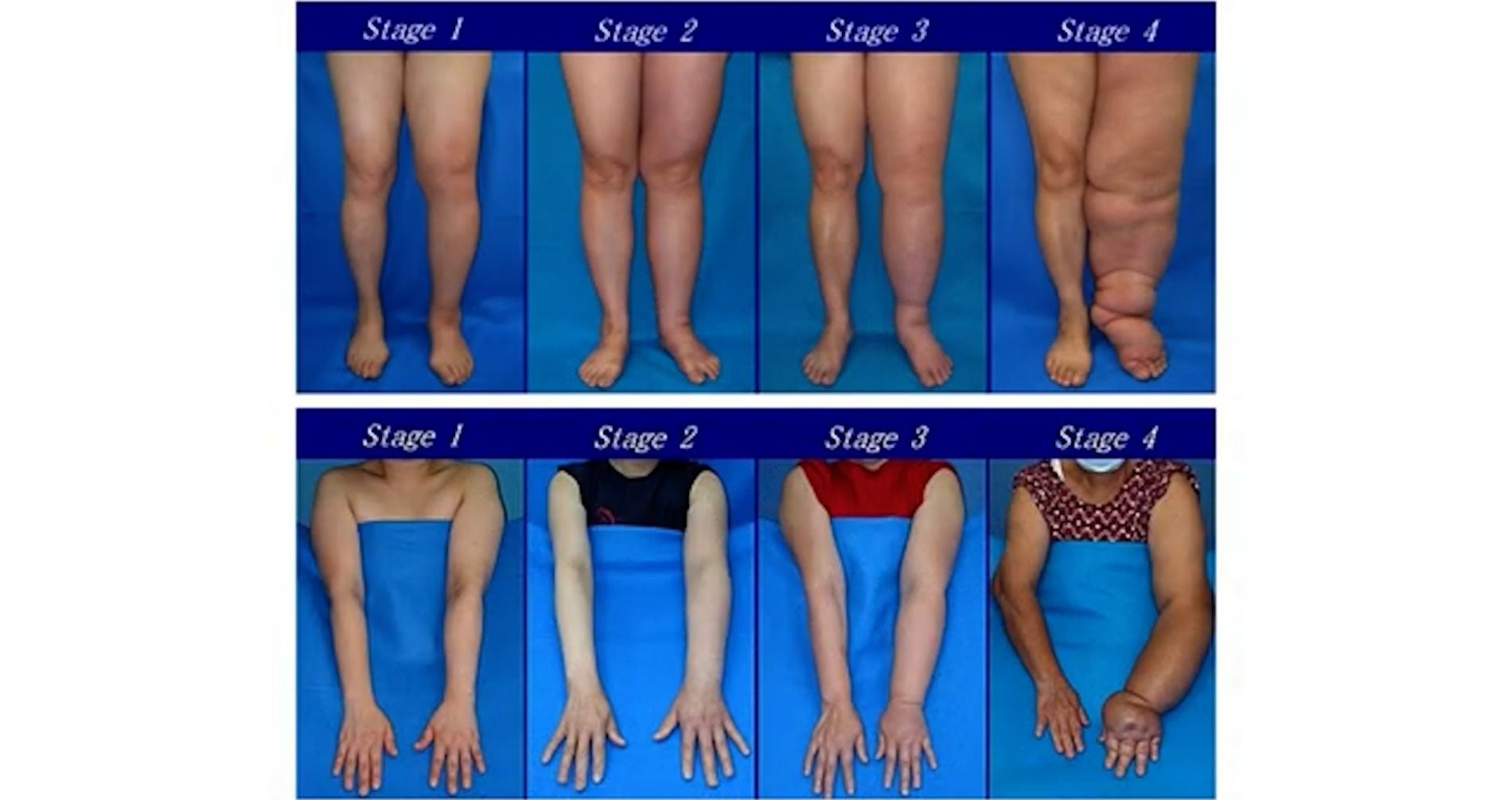 Non è cellulite, ma lipedema. È una malattia e colpisce le donne