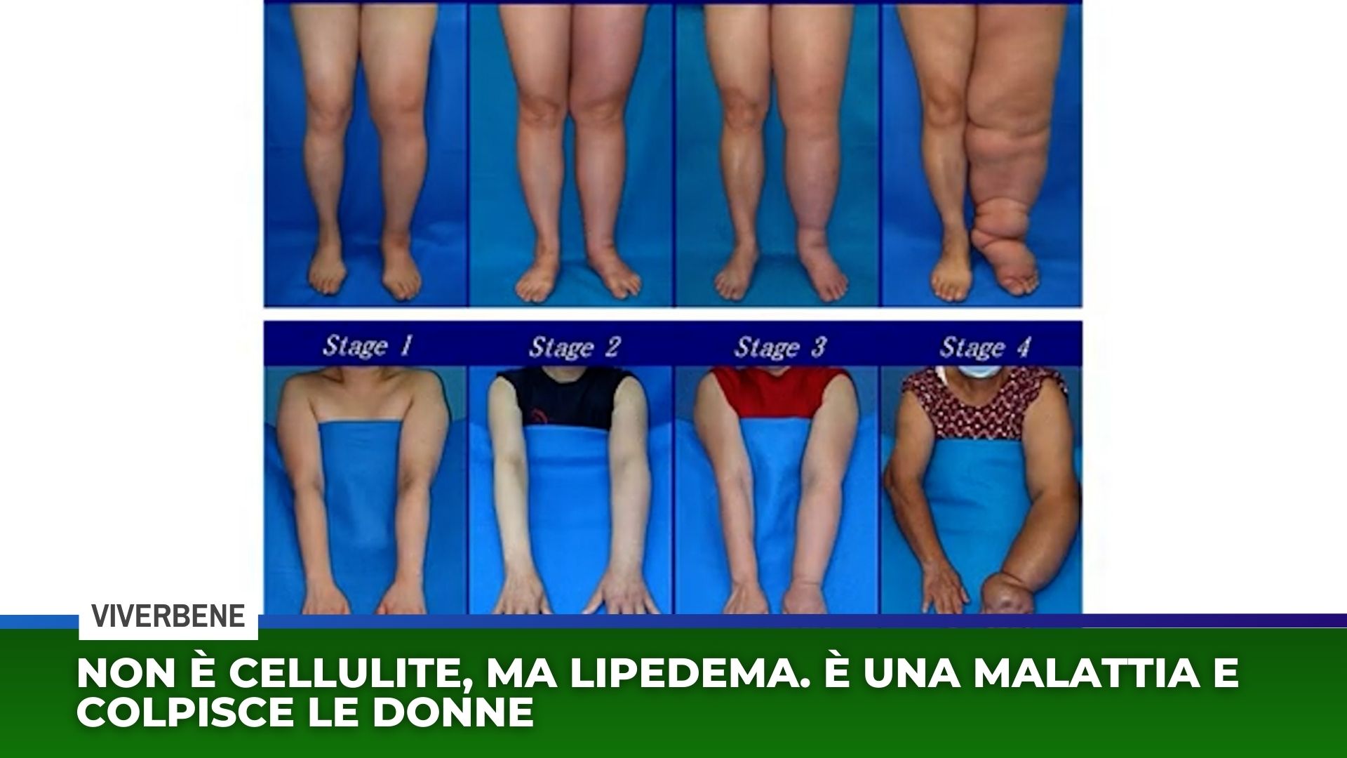 Lipedema, la malattia che colpisce le donne